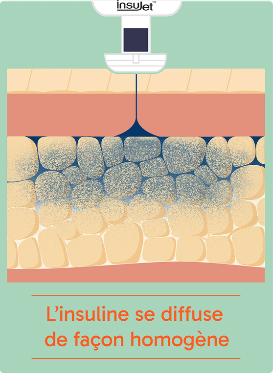 The advantages of jet injection